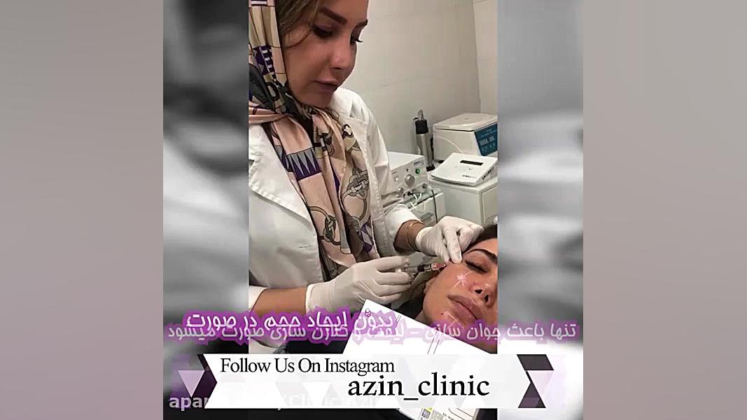 تزریق ژل پروفایلو به صورت