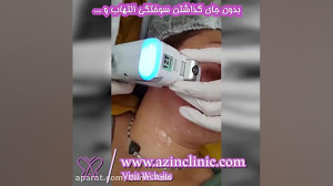 جوانسازی پوست با هایفوتراپی