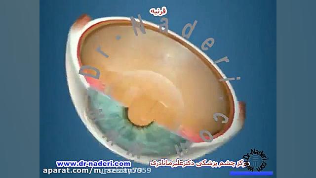 قرنیه  ساختان چشم