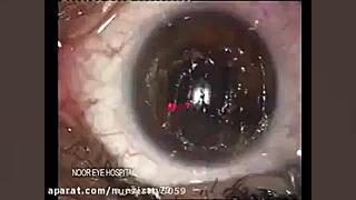 عمل جراحی پی ار کی چشم