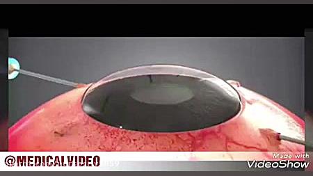 یک ویدیو جالب انيميشن جراحي قر...