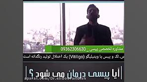 پیسی و ویتیلیگو چیست راه درمان...