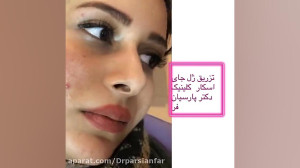 درمان اسکار اتروفیک ناشی از جو...