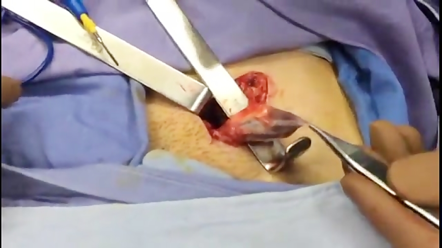 درمان واریکوسل با جراحی باز پر...