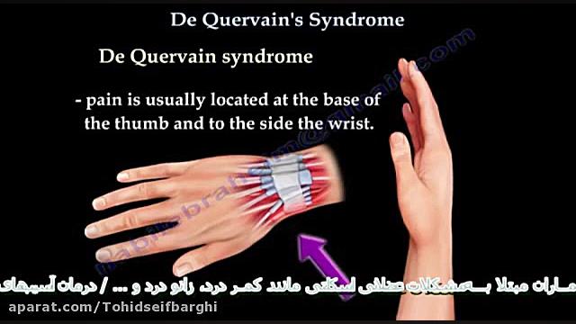 بیماری مچ دست، دکرون دکتر توحی...