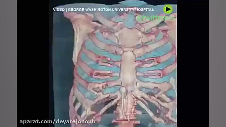 حمله کرونا ویروس به ریه را ببی...