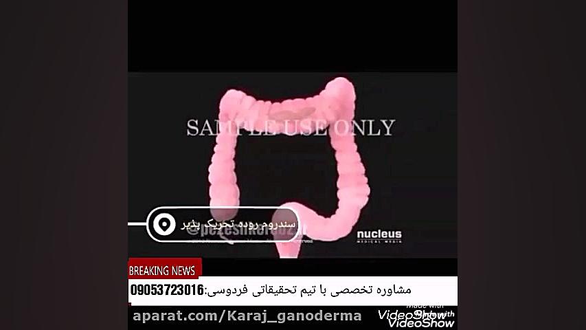 درمان سندرم روده تحریک پذیر چگ...