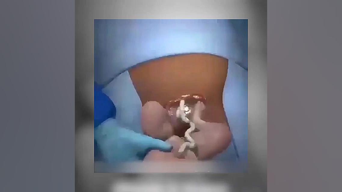 زایمان سزارین | دکتر کاظمی متخ...