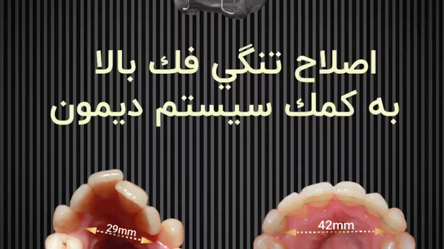 اصلاح تنگی فک بالا به کمک سیست...