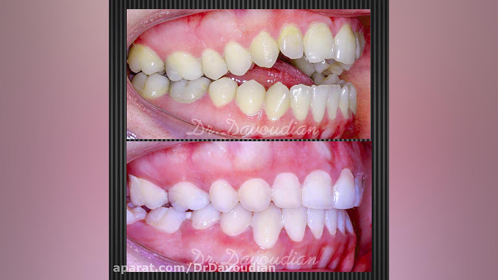 ارتودنسی اپن بایت شدید بدون جر...