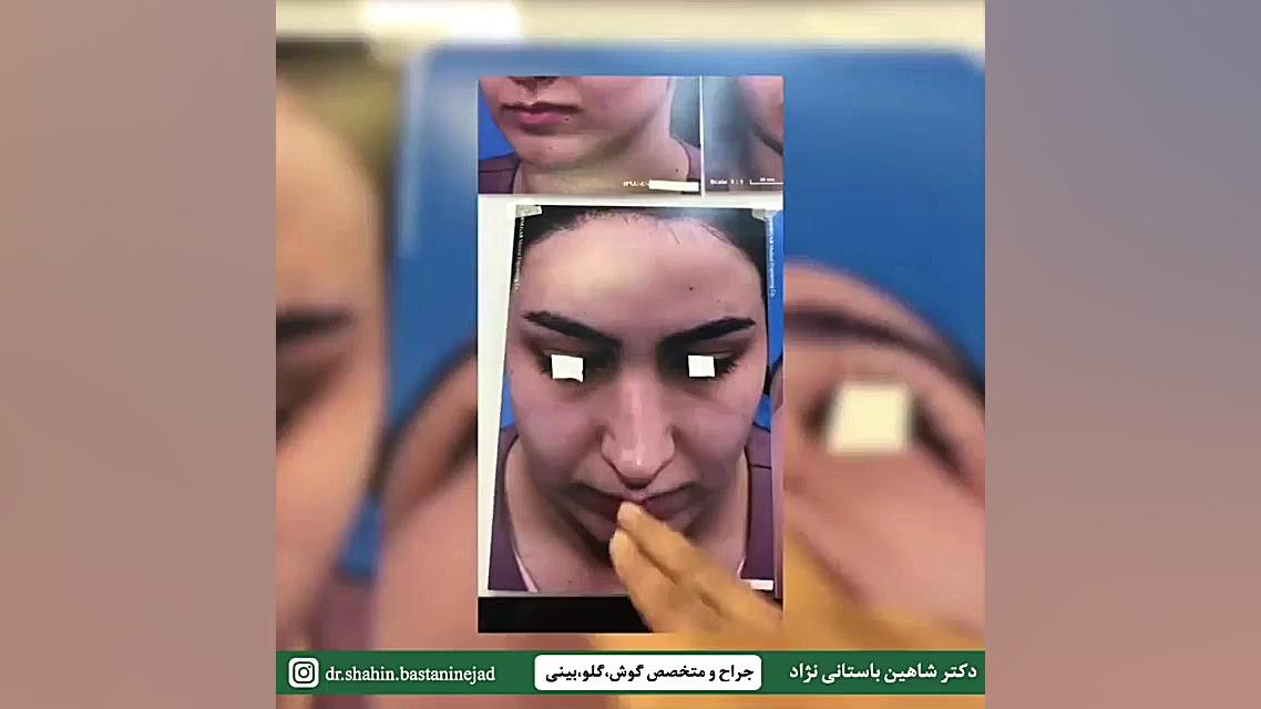 فیلم نتیجه جراحی ترمیمی بینی د...