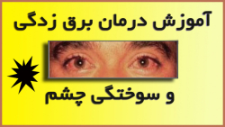 آموزش درمان برق زدگی و سوختگی...