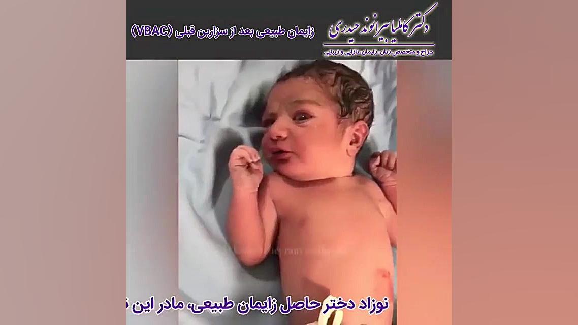 زایمان طبیعی بعد از سزارین | د...