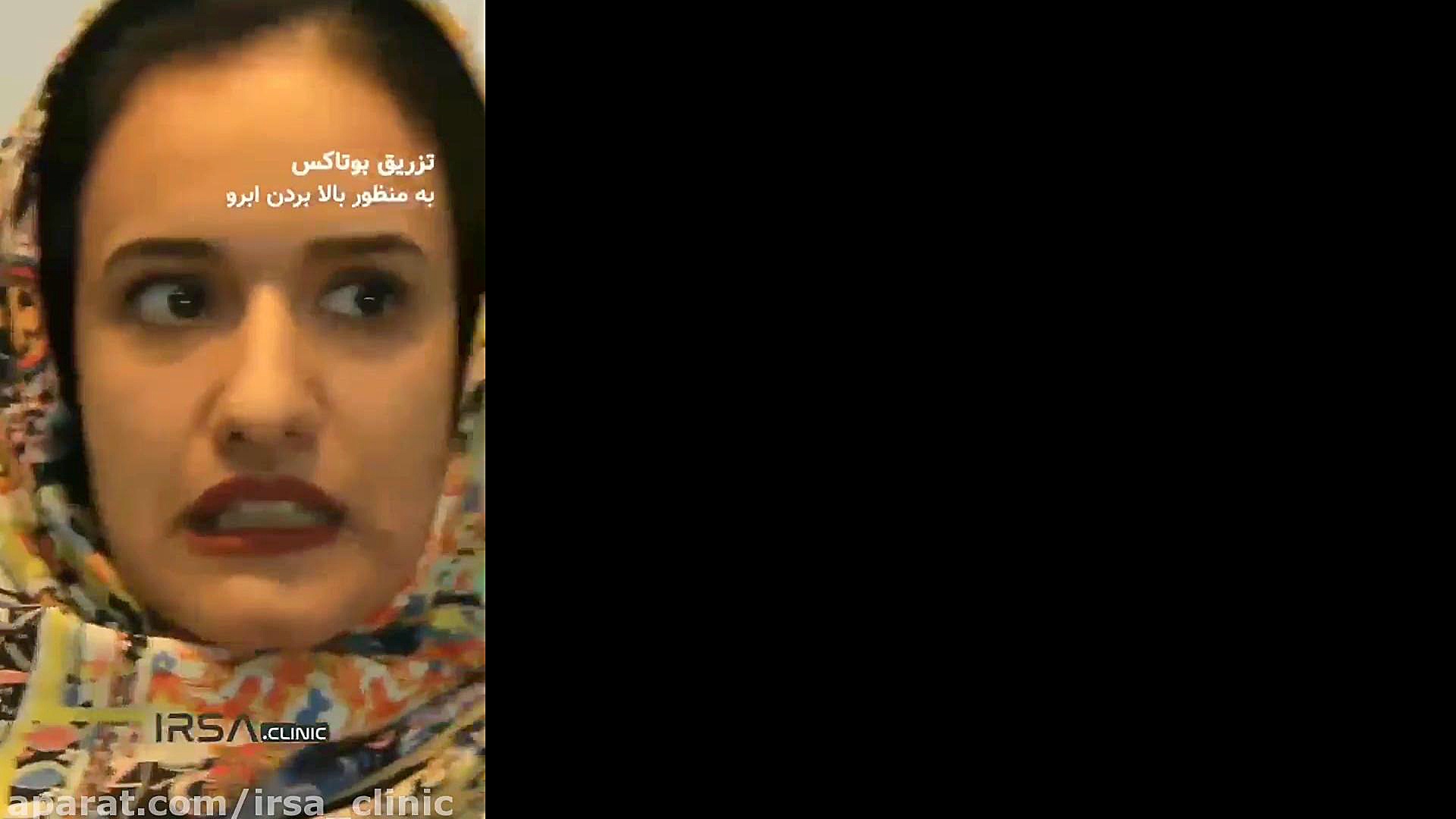 بوتاکس لیفت ابرو چیست؟