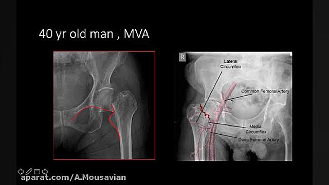 آسیبهای هیپ
