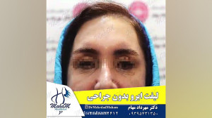 لیفت ابرو بدون جراحی