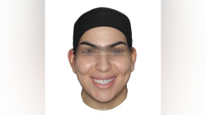 ارتودنسی اپن بایت شدید | دکتر...