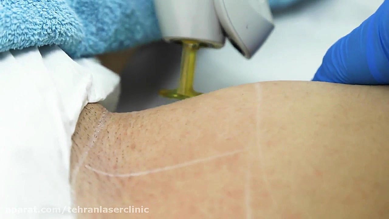 لیزر موهای زائد بر روی زیر بغل