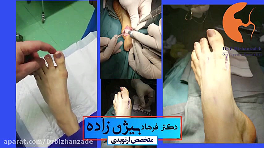 فیلم عمل جراحی هالوکس والگوس