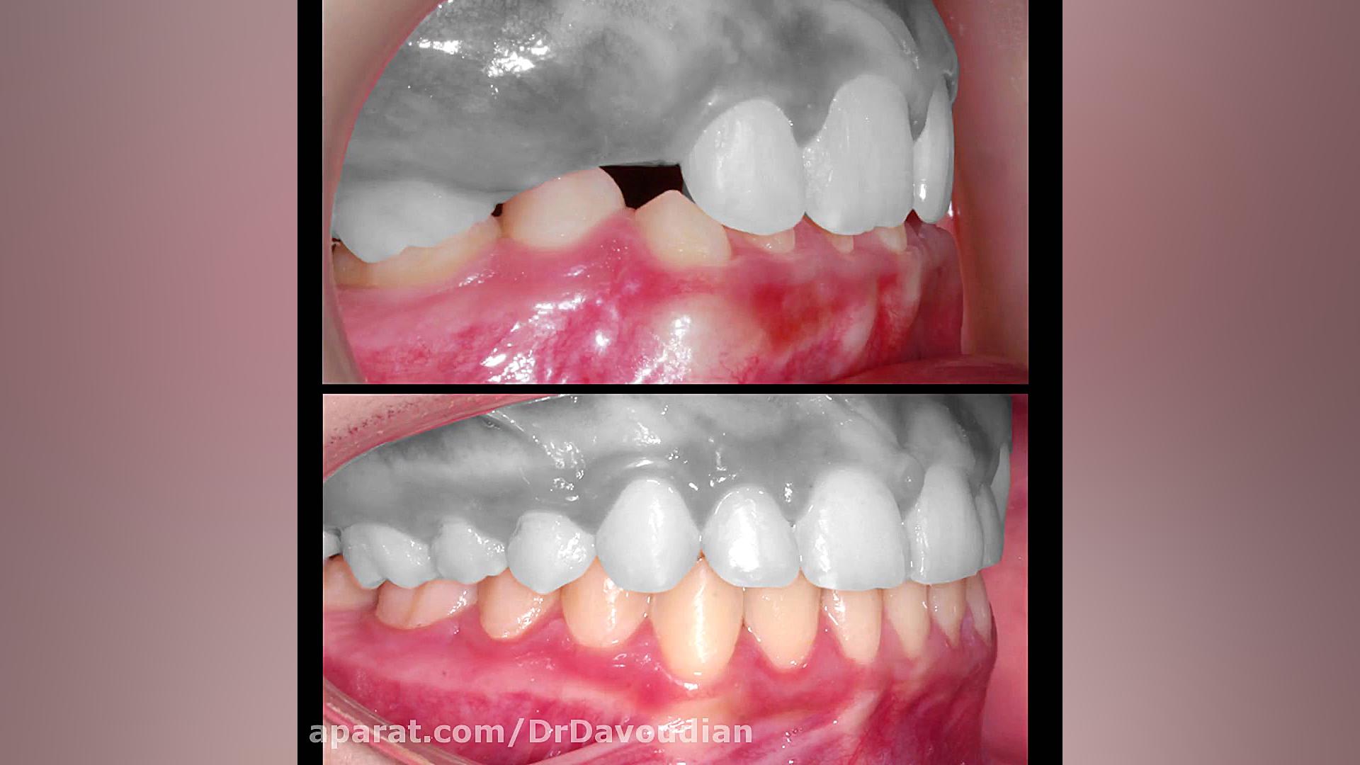 ارتودنسی دیپ بایت و انحراف مید...