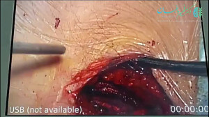 عمل جراحی میکروسکوپیک دیسک کمر