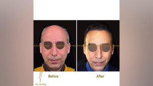 فیلم کاشت مو