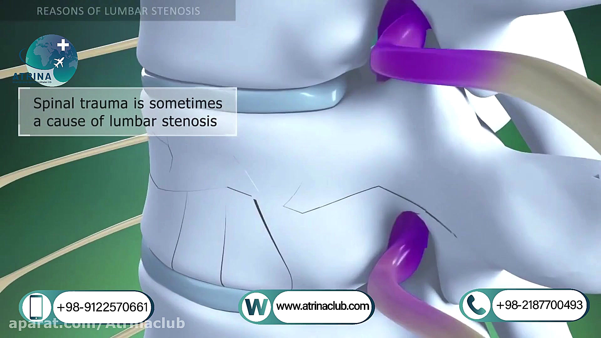 lumbar spinal canal stenosis i...