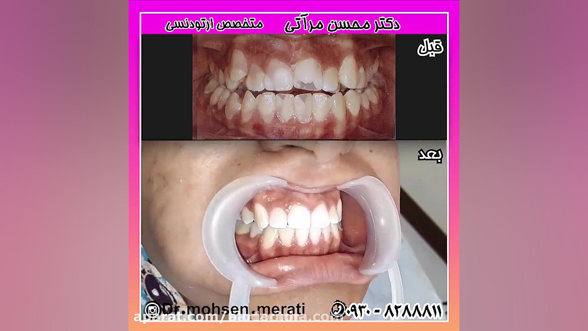 الو دکتر درمان بیرون زدگی فک پ...