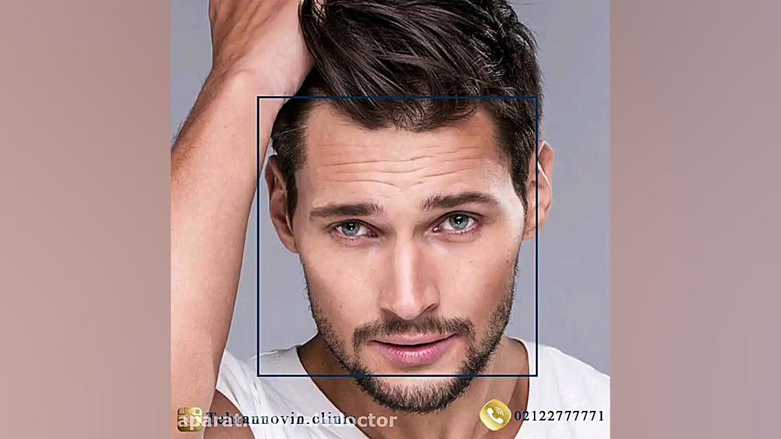 الو دکتر مراحل عمل کاشت مو