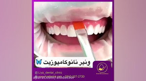 الو دکتر ونیر نانو کامپوزیت بد...