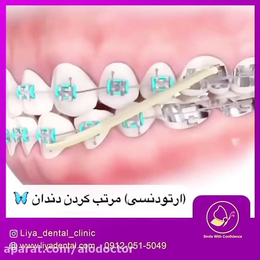 الو دکتر روش های مختلف ارتودنس...