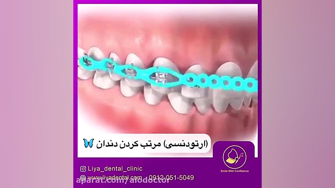 الو دکتر روش های مختلف ارتودنس...
