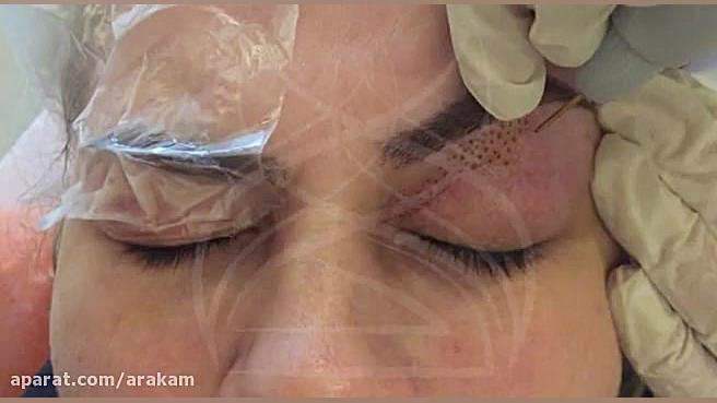 رفع افتادگی پلک با پلاسما جت