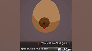 تشخیص زودرس سرطان سینه توسط خو...