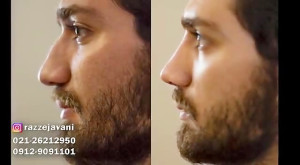 اصلاح قوس بینی و نوک بینی در ۲...