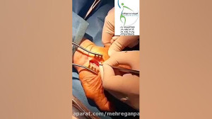 آزاد کردن عصب دست در بیماری سن...