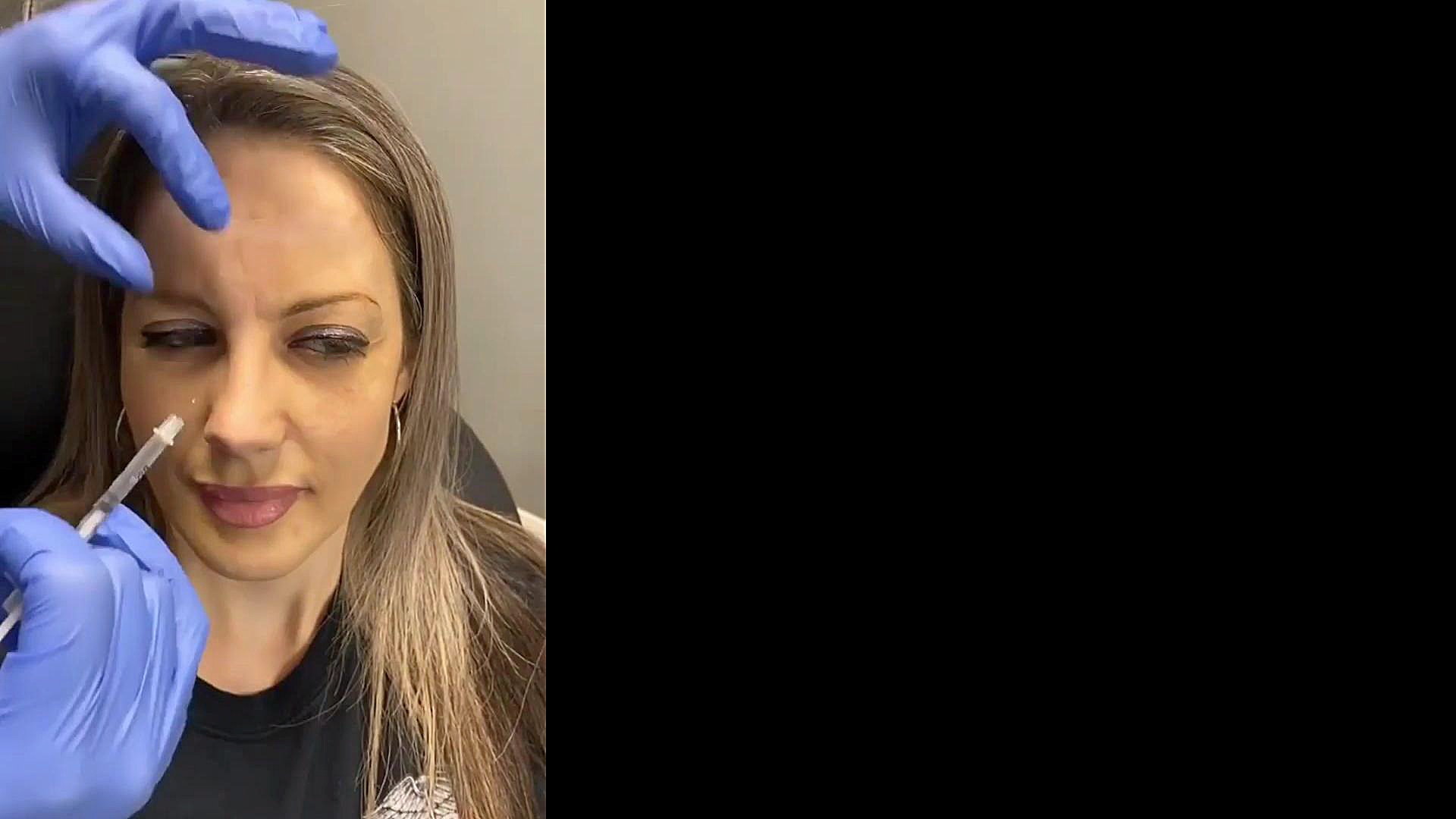 استفاده از بوتاکس برای لیفت اب...