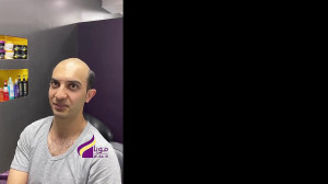 نصب پروتز مو موبا