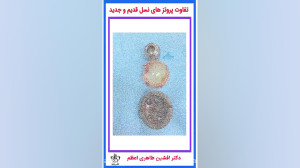 تفاوت پروتزهای نسل قدیم و جدید...