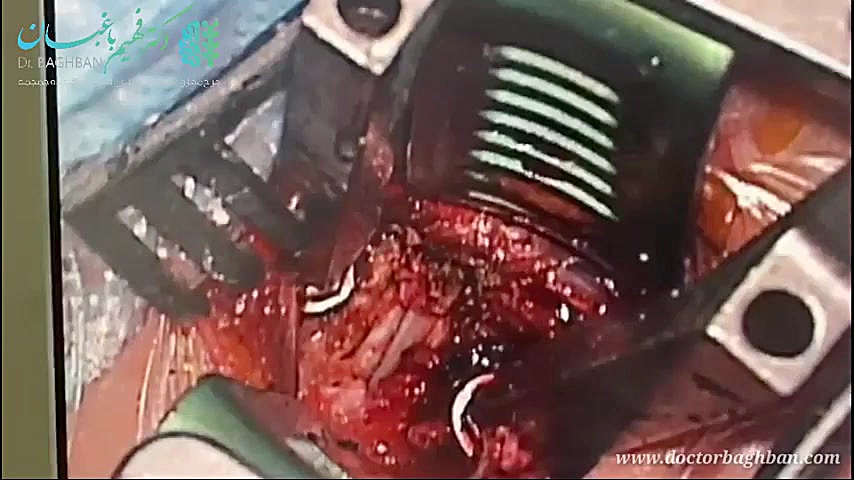 جراحی دیسک گردن در خانم میانسا...