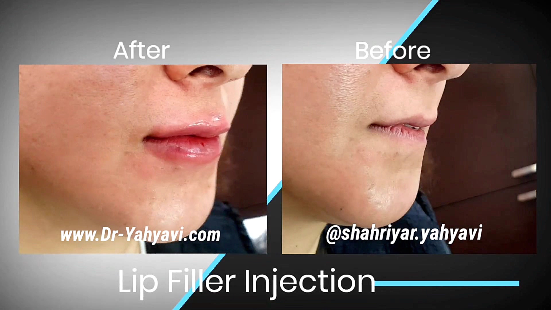 بلافاصله پس از تزریق فیلر لب ت...