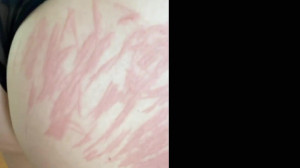 hifutreatment Right after the...