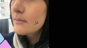 الکساندرایت تزریق یک سی سی فیل...