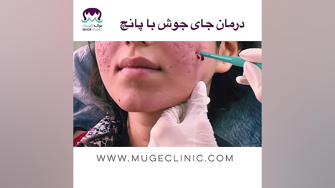 درمان جای جوش با پانچ موگه کلی...
