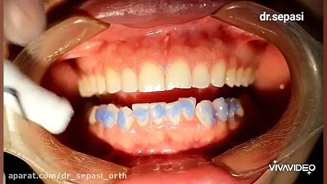 مراحل نصب براکت ارتودنسی به رو...