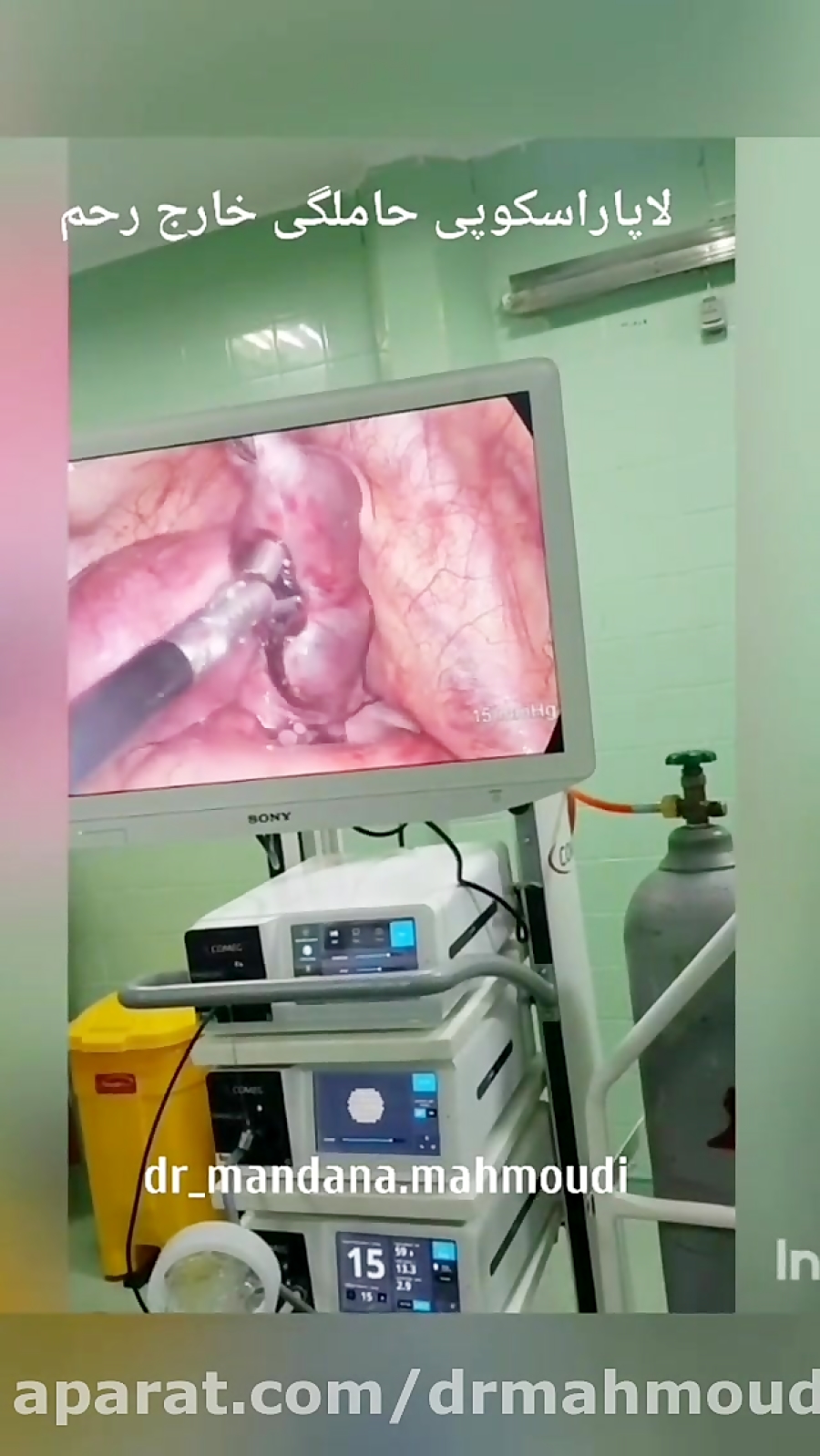 فیلم حاملگی خارج از رحم