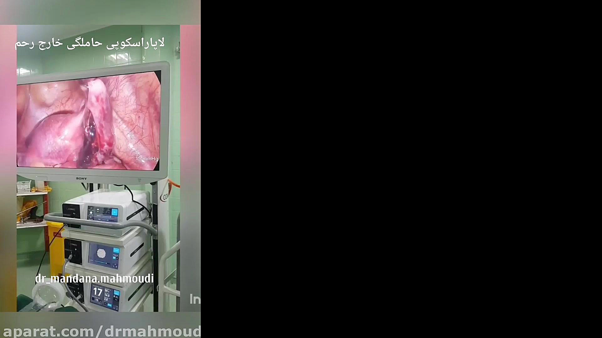 فیلم حاملگی خارج از رحم