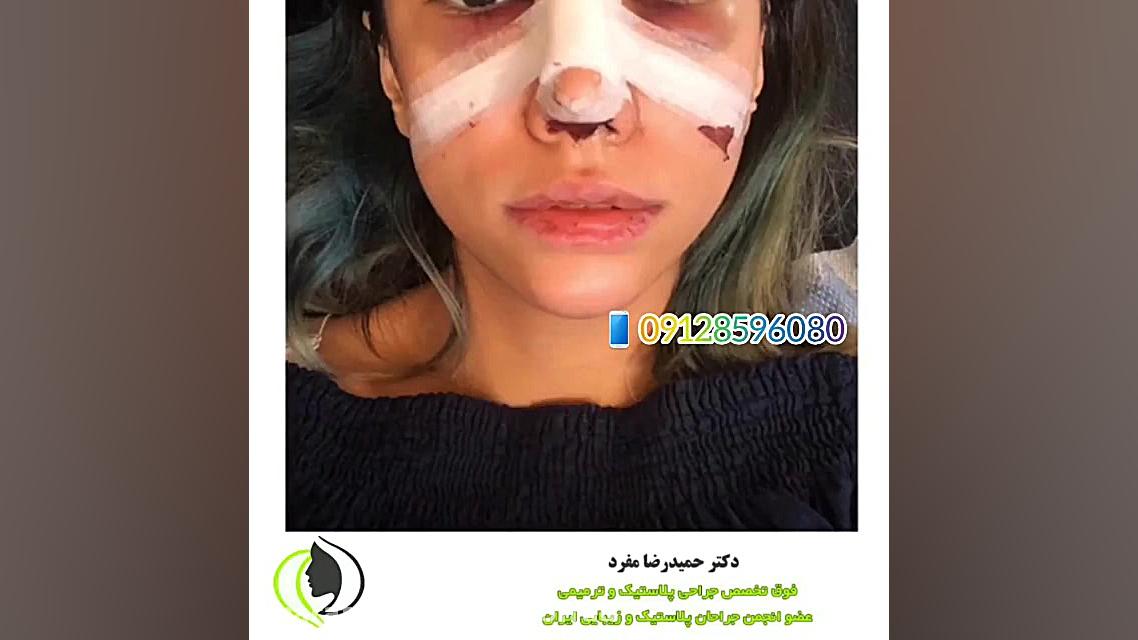 روند بهبودی بعد از عمل زیبایی