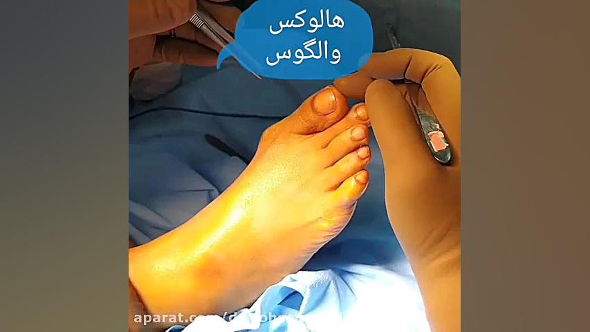 جراحی انحراف انگشتان شست هر دو...