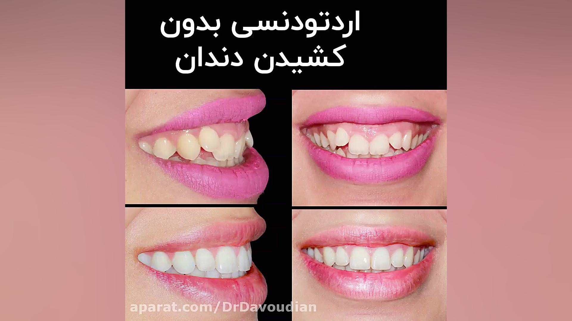 ارتودنسی بدون کشیدن دندان | دک...